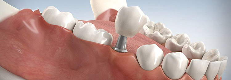 Zahn­implantate